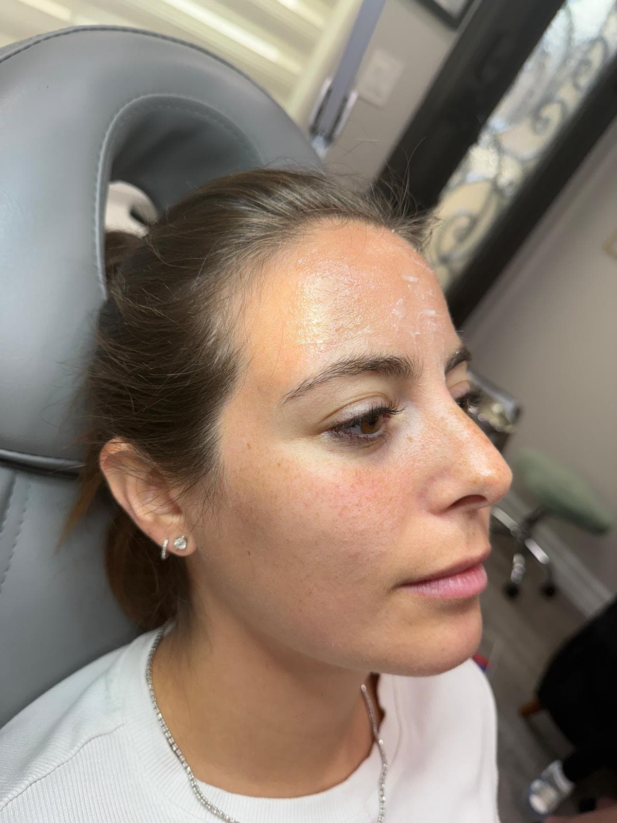 XERF Skin Tightening