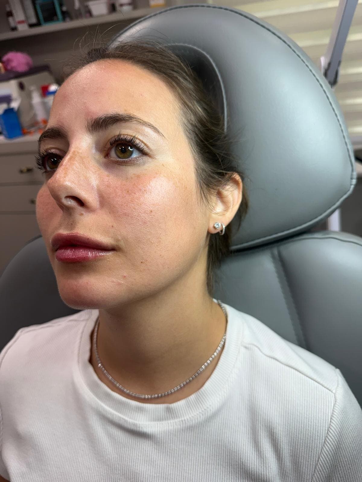 Mesotherapy