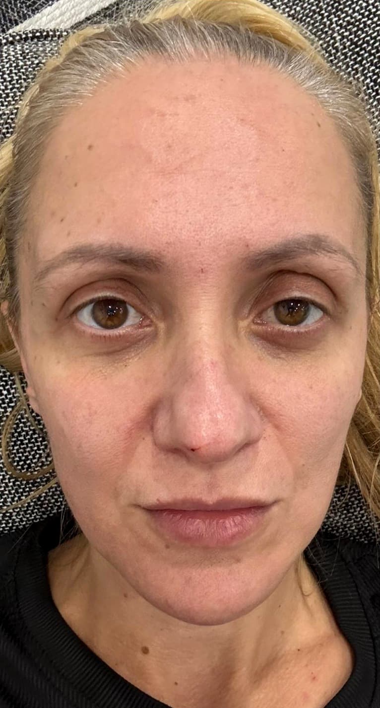 Under-eye hollowing, after treatment