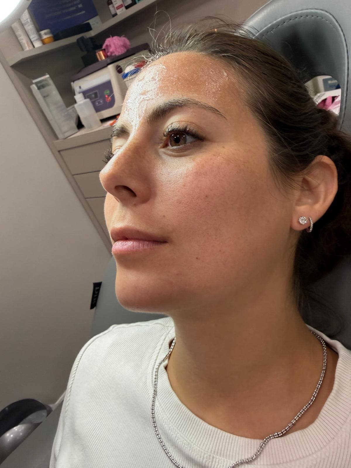 Microneedling