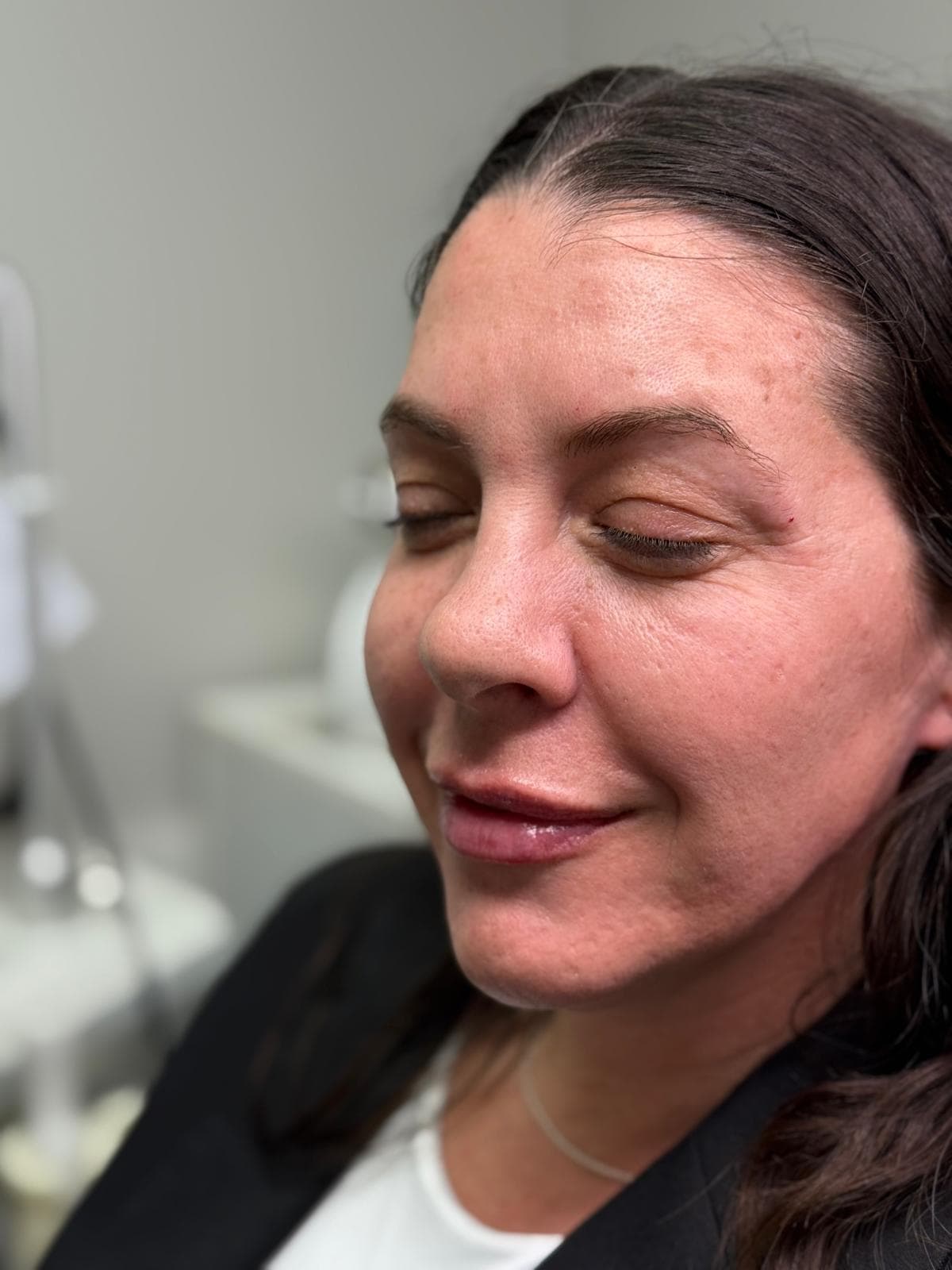 PRP Therapy