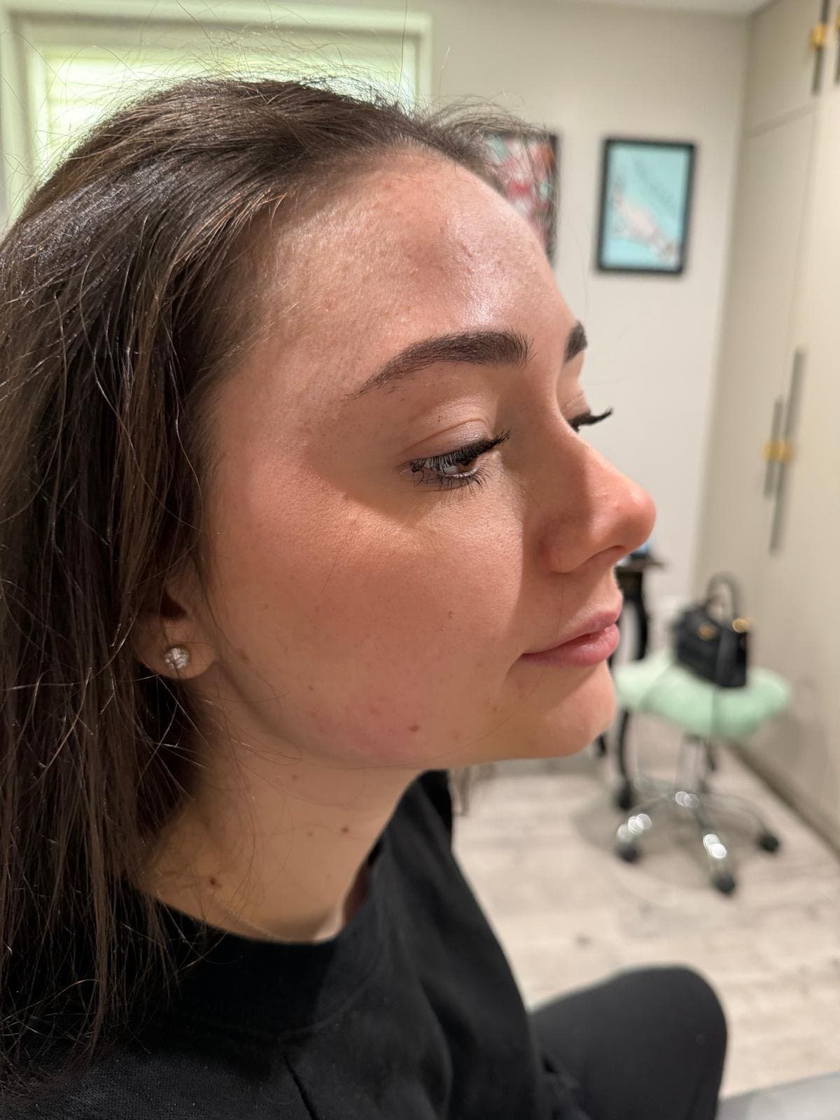 Chemical Peels